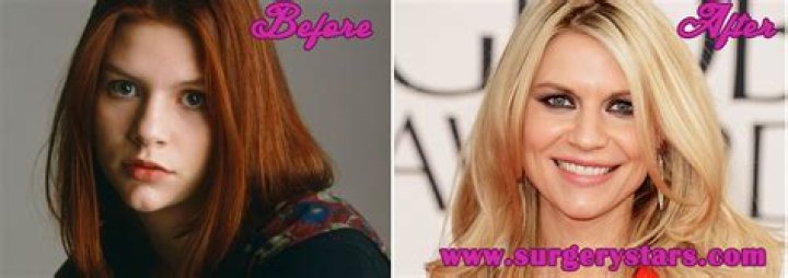 Claire Danes Plastic Surgery Before and After