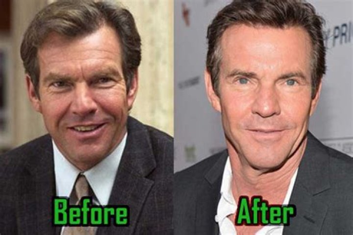 Dennis Quaid Plastic Surgery: Dennis's Choice to Avoid Signs of Aging!