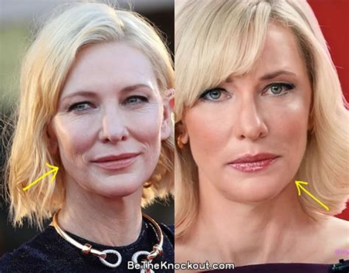 
Did Cate Blanchett Get Plastic Surgery? Truth Revealed Here 