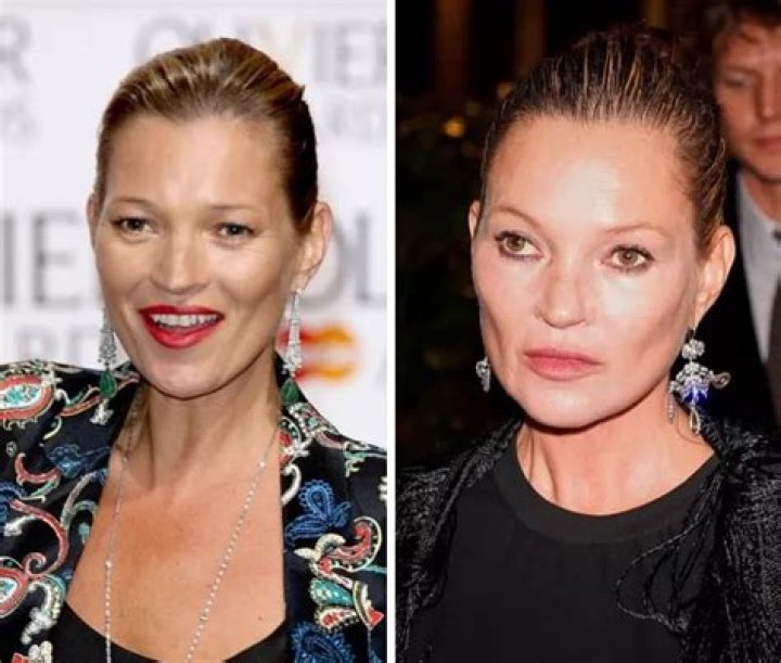 Did Kate Moss Undergo Plastic Surgery? Model’s Fresh Face And Lips Changes Sparks Rumors