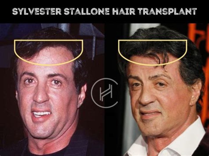 Did Sylvester Stallone have a speech impediment?
