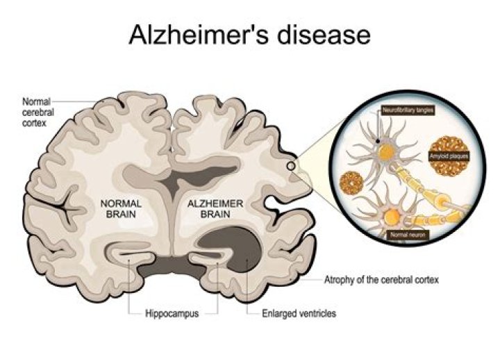 
Does MontanaBlack Have Alzheimer Disease? Get To Know About The Youtuber’s Health Condition 