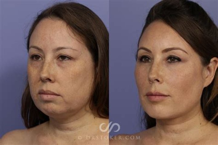 Has Alexandra Rose Had Plastic Surgery On Chin? Before And After Photos On IG