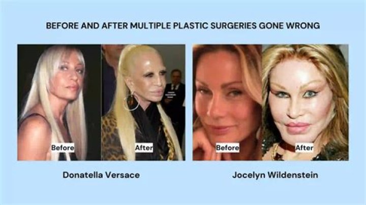 
Jocelyn Wildenstein Plastic Surgery Gone Wrong! Before And After Photos 