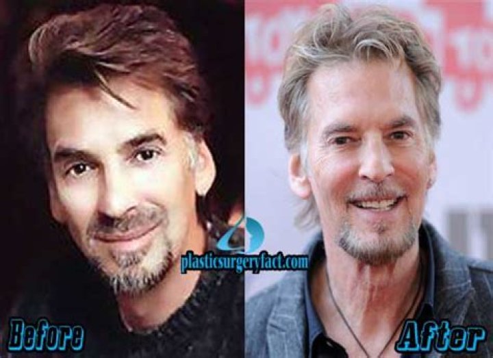 Kenny Loggins Plastic Surgery: A Deep Dive into the Speculations