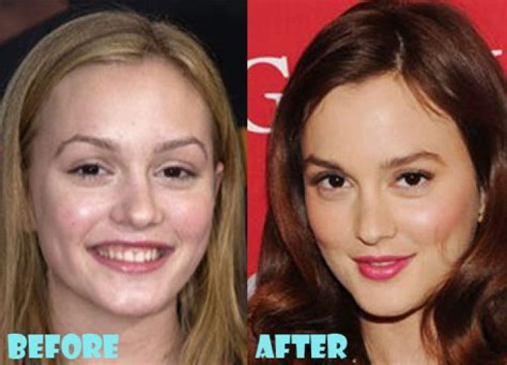 Leighton Meester Plastic Surgery Before and After
