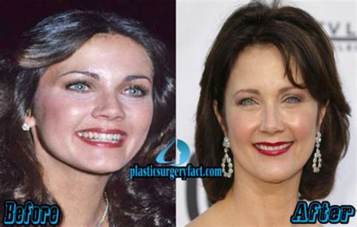 Lynda Carter Plastic Surgery: Delving Into the Truth Behind the Speculations