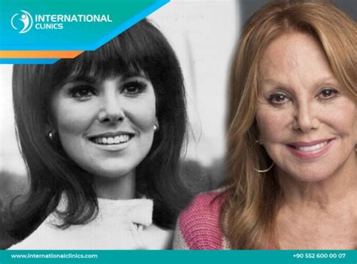 Marlo Thomas Plastic Surgery: Aging Gracefully or Going Under the Knife?