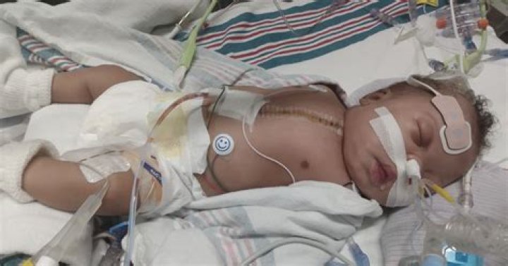 
Nine-day old baby undergoes heart surgery in UP hospital 