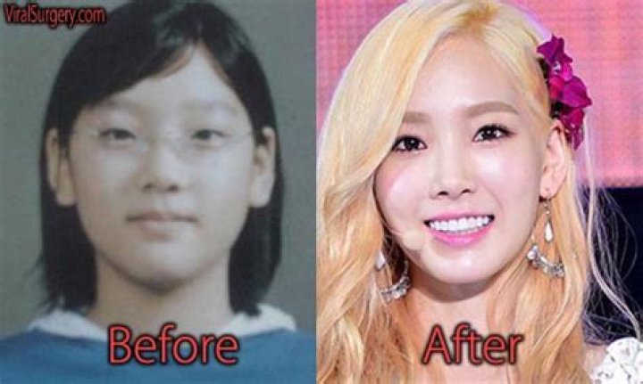 Taeyeon Opens Up About Her Plastic Surgery Speculation: “My mom's heart will ache”!