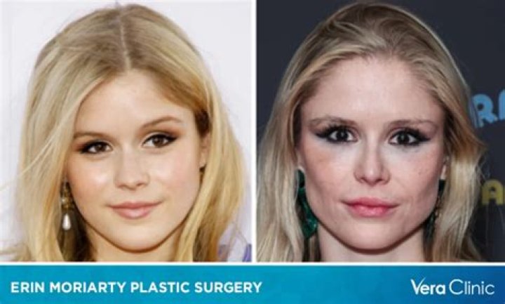 What happened to Erin Moriarty? Erin Moriarty’s plastic surgery explained